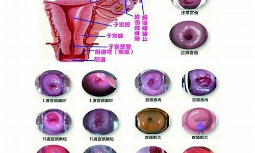 宫颈炎这种病严重吗_宫颈疾病宫颈炎