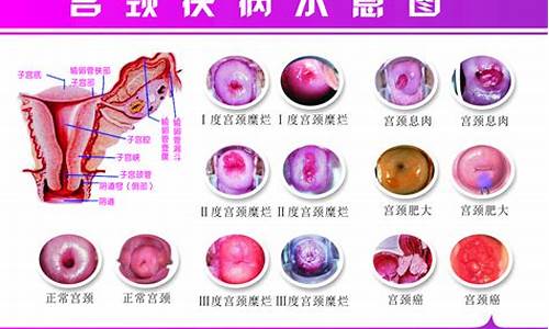 宫颈疾病怀孕_宫颈疾病怀孕会流产吗