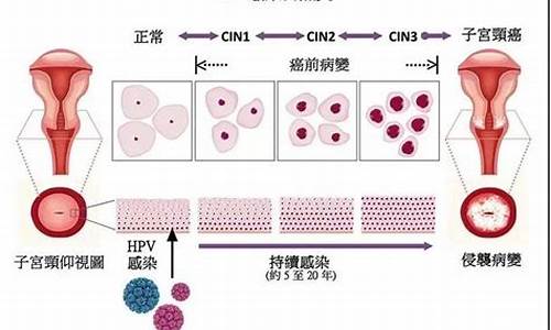 宫颈治疗的方法_宫颈疾病早治疗