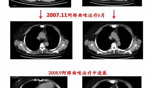 乳腺癌晚期_乳腺癌晚期图片 溃烂