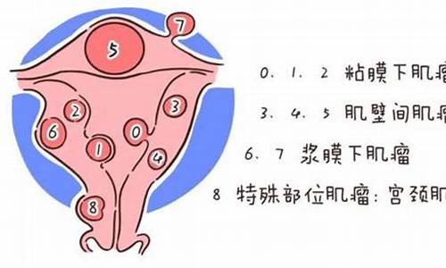 妇科炎症子宫肌瘤_子宫有炎症