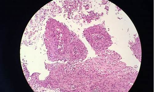 宫颈疾病组织病理学检查_宫颈组织病理学检查多少钱