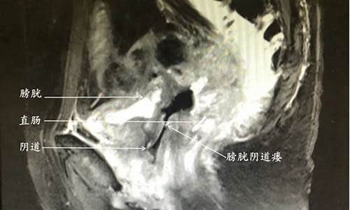 妇科微创妇科肿瘤_妇科微创手术有哪些项目