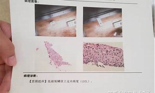 分泌物检验能验出宫颈疾病吗_验分泌物能查出有没有宫颈癌吗