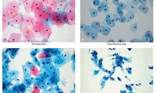 宫颈疾病有哪些症状_宫颈疾病tct
