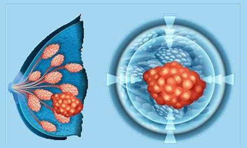 乳腺增生的主要症状有哪些_乳腺癌的症状