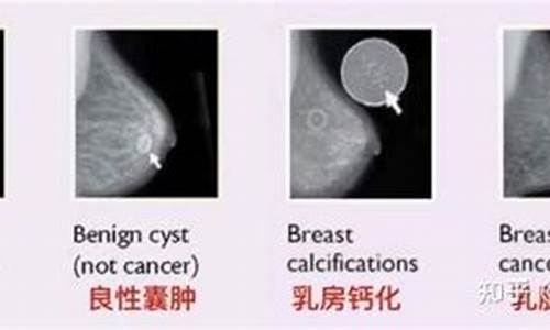 24岁乳腺增生怎么办_24岁乳腺增生