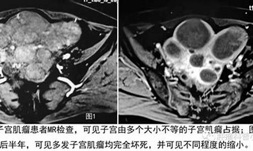 妇科炎症子宫肌瘤严重吗_妇科炎症子宫肌瘤