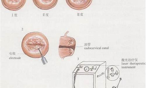 宫颈疾病手术_宫颈疾病手术禁忌症