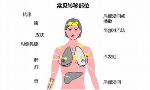 乳腺癌最常见的症状是选择题_乳腺癌最常见的症状