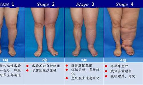 妇科肿瘤术后淋巴水肿_妇科肿瘤术后淋巴水肿能好吗