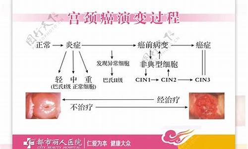 宫颈疾病癌变导火线_宫颈变癌症治的好吗